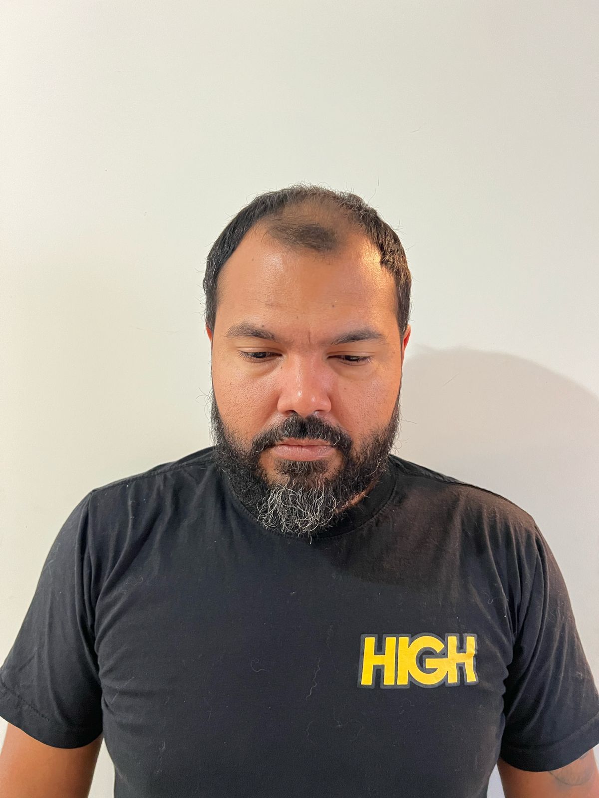 Antes do transplante capilar — topo rarefeito
