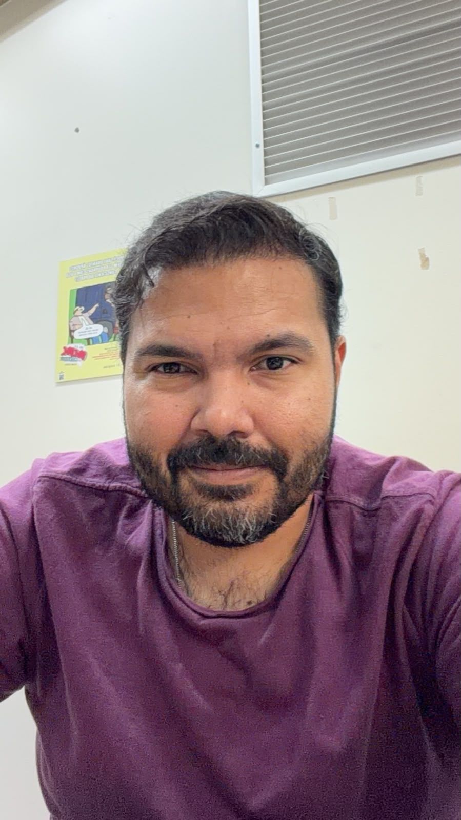 Depois do transplante capilar — densidade recuperada