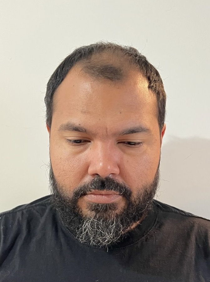Antes do transplante capilar — rarefação na região frontal